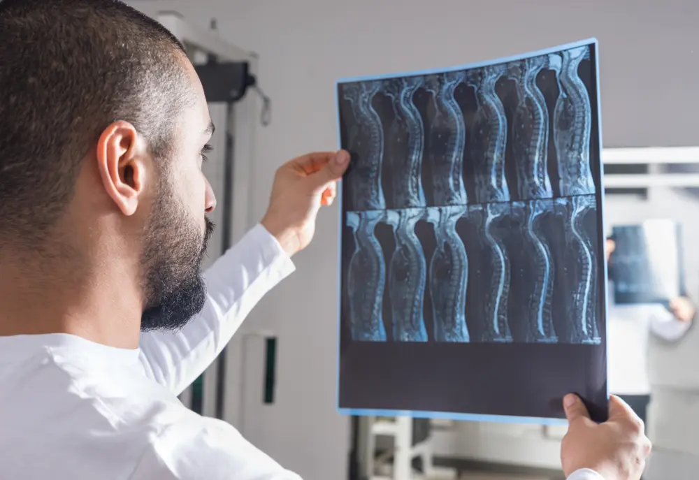 Implante de estimulador medular