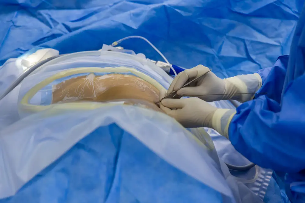 Endoscopic Discectomy