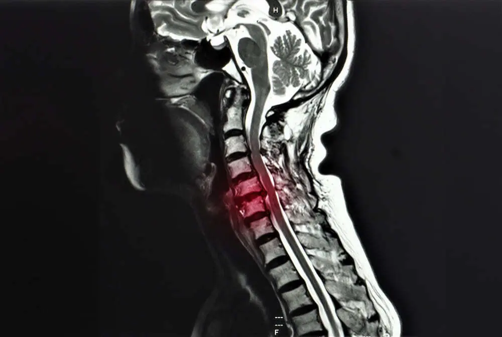 Cervical spine MRI showing spinal cord compression related to degenerative myelopathy and spinal decompression surgery