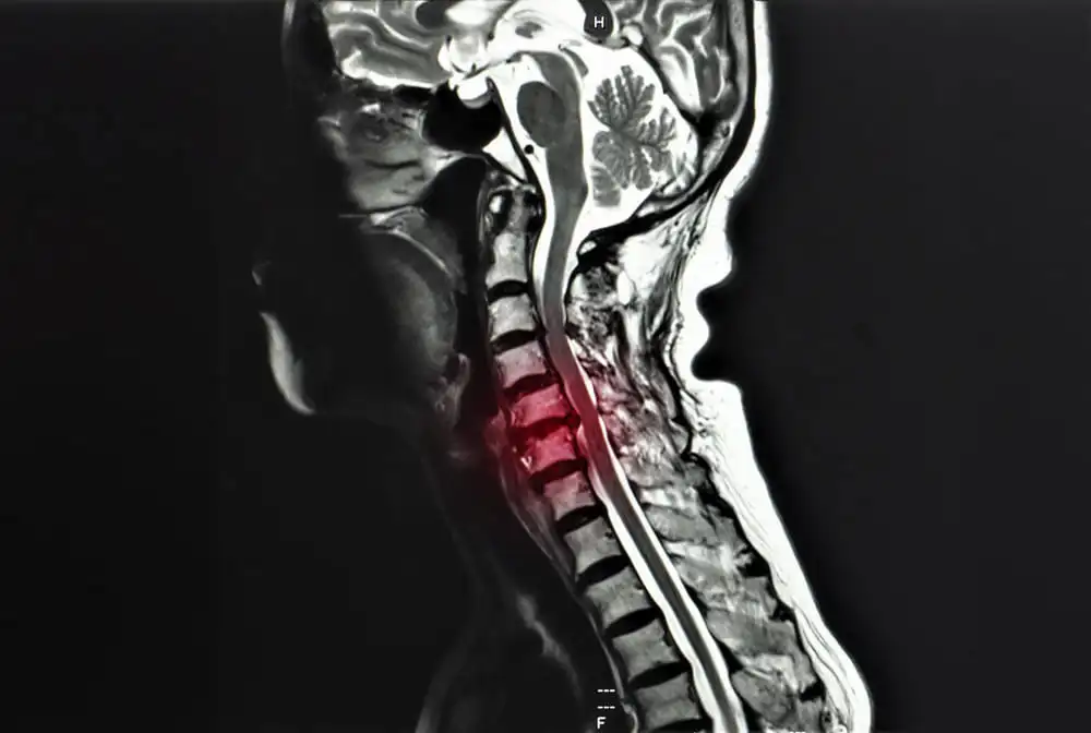Myelopathy Treatement in New York