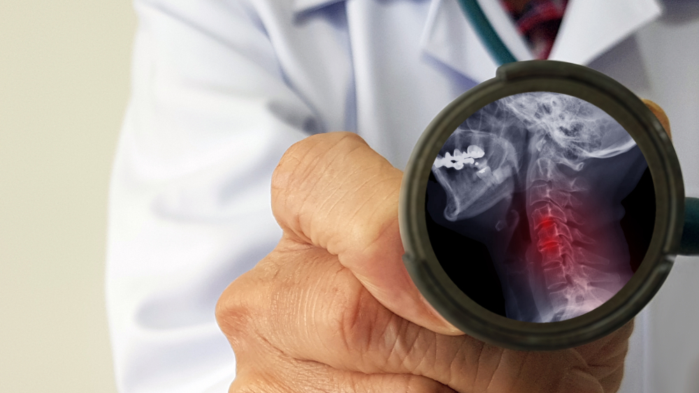 Radiculopathy Treatment in New York