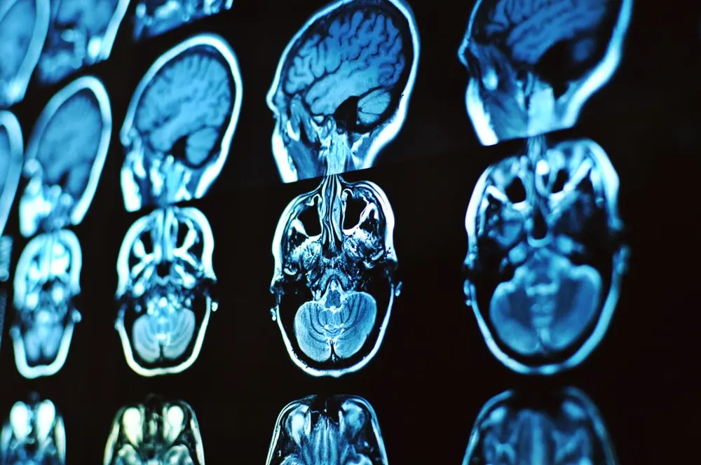 Neurology X-rays showing brain scans for accident injury diagnosis
