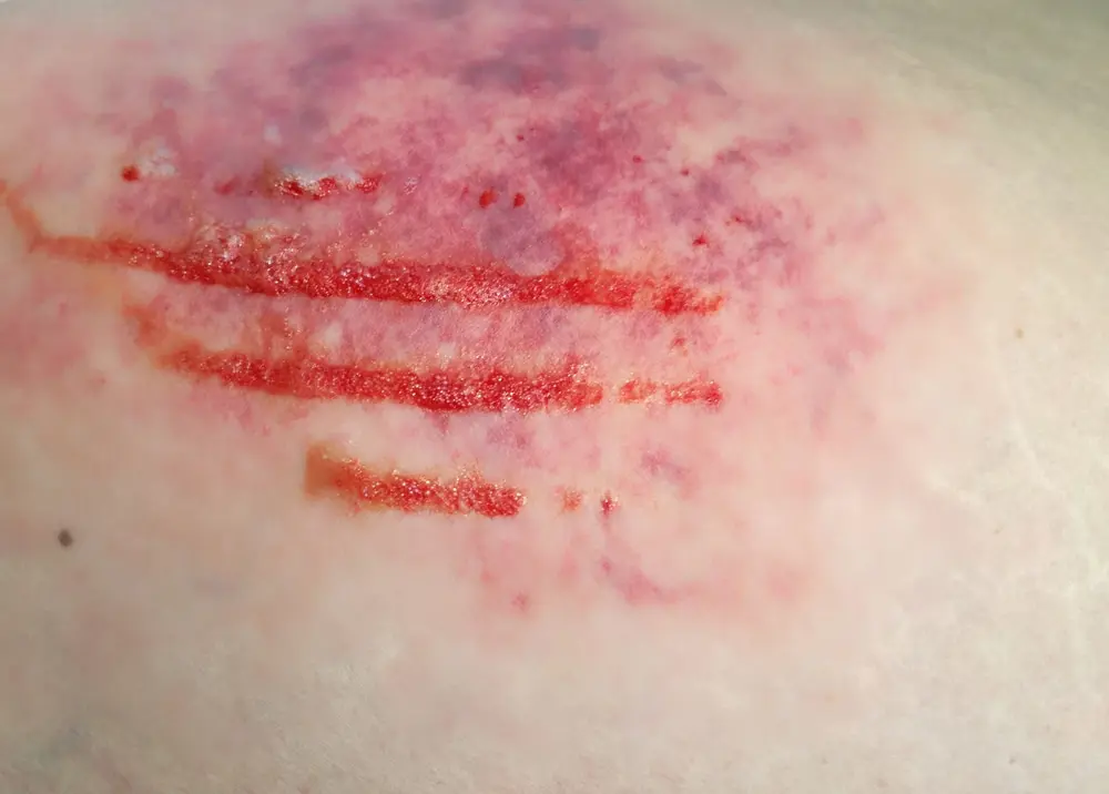 image of a soft tissue injury after a car accident