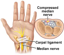 Diagrama anatómico del síndrome del túnel carpiano que muestra el nervio mediano comprimido debajo del ligamento carpiano en la muñeca y la mano.