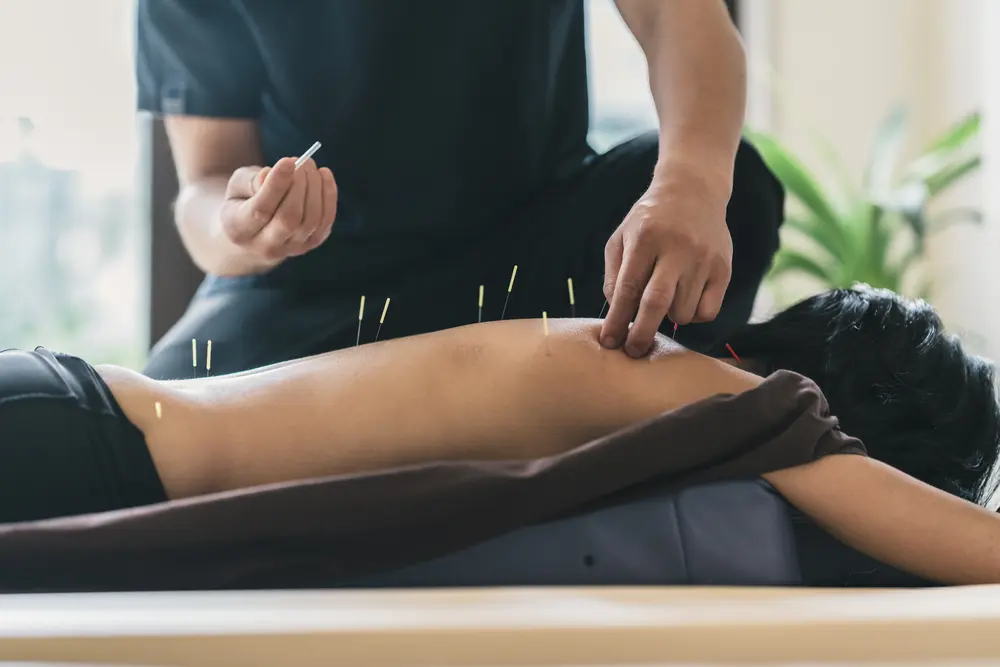 Acupuncturist Near Me