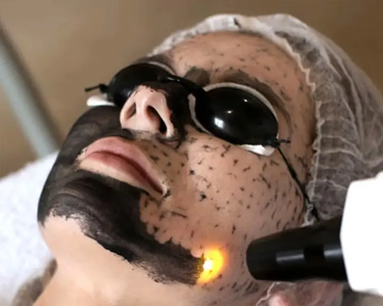 Client wearing protective eyewear while a laser handpiece is used on the cheek