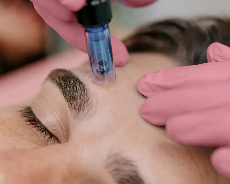 Gloved hands using a handheld skin treatment device on a client's forehead
