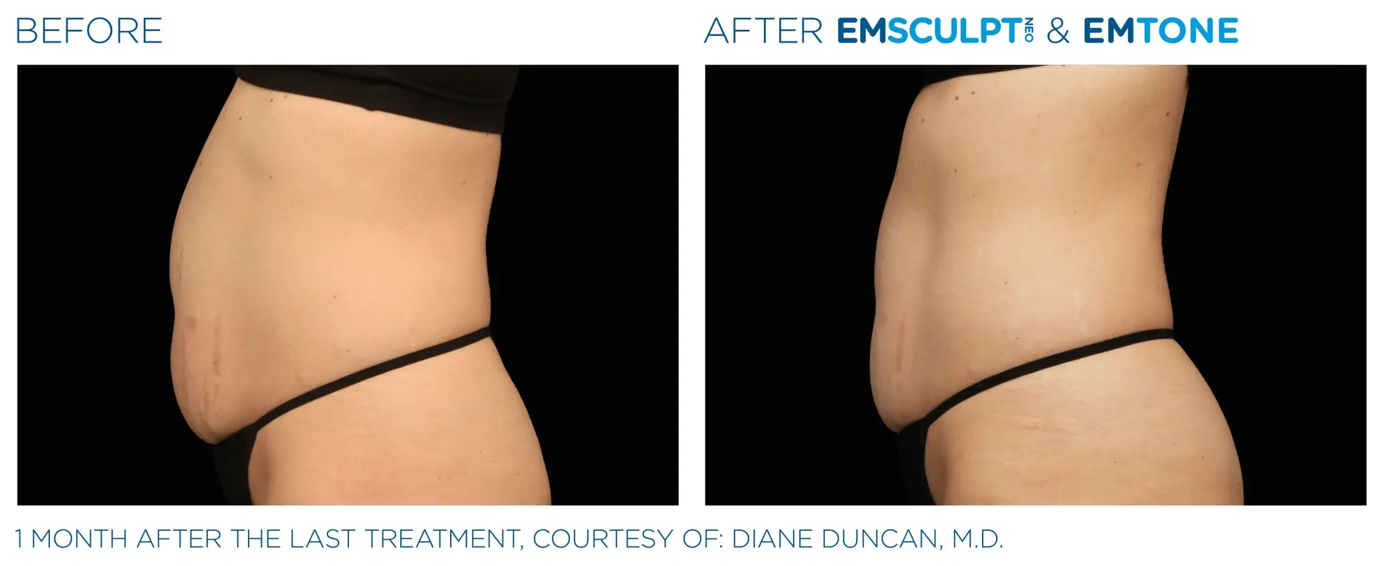 EmSculpt Neo® for Abs