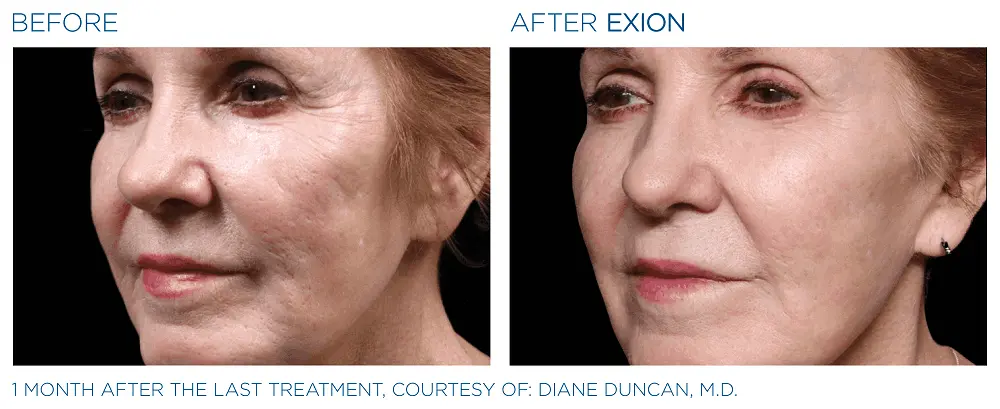 EXION Before and Afters